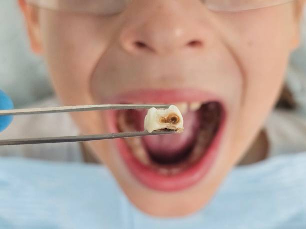 Best Dentist for Tooth Abscess  in Marceline, MO